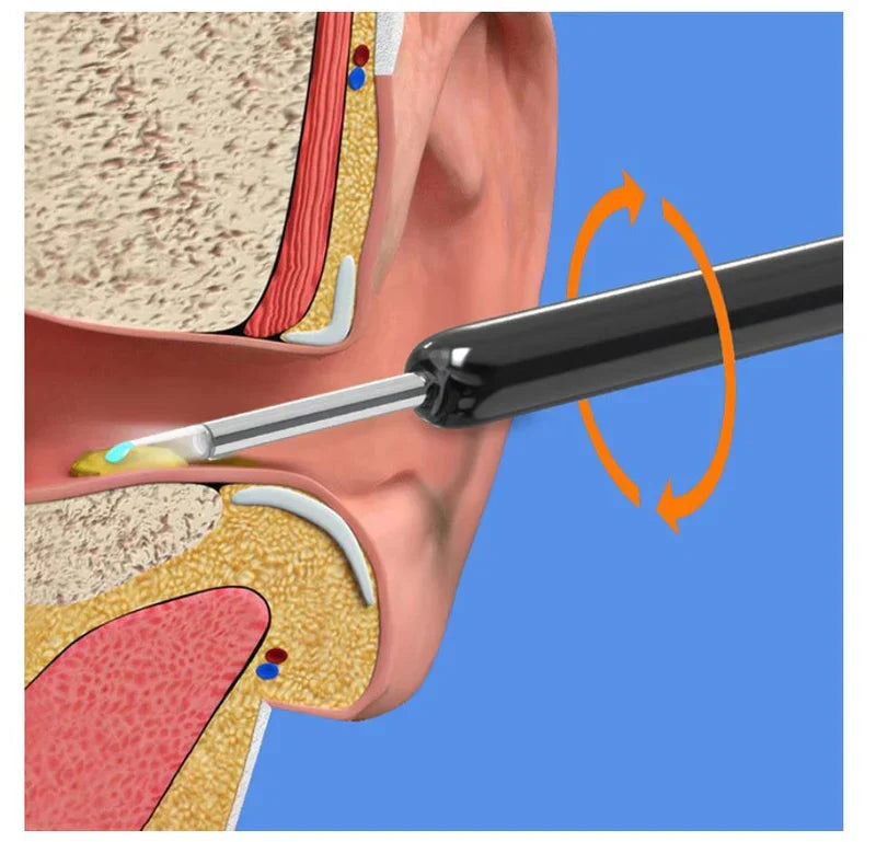 Earwax Removal Kit || مجموعة إزالة شمع الأذن
